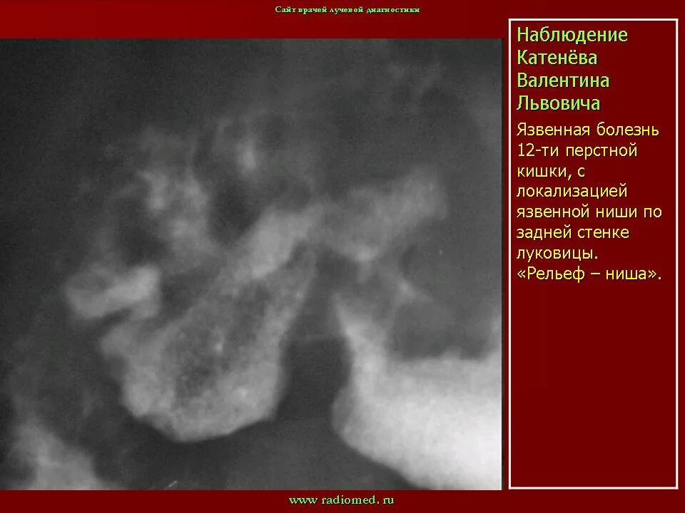 Язвенная болезнь 12 перстной кишки рентген. Язва луковицы 12 перстной кишки рентген. Рубцово язвенная деформация 12п кишки. Рубцовая деформация луковицы двенадцатиперстной кишки на рентгене. Язва 12 ти