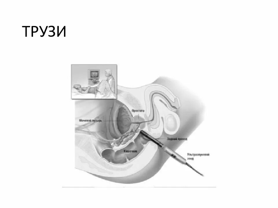 Трузи предстательной железы подготовка к исследованию. Трансректальное УЗИ У женщин. Размер датчика трузи.