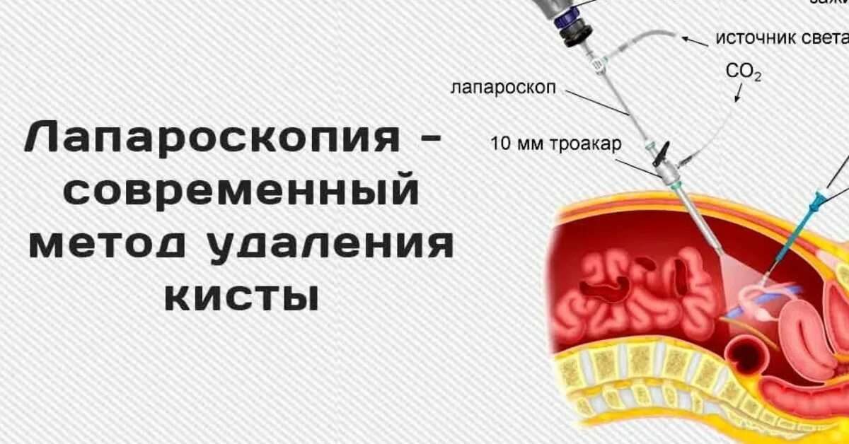 Препараты после удаления яичников. Гинекологическая лапароскопия. Лапароскопия кисты яичника.