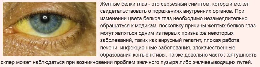 Причины пожелтения глаз. Желтоватый оттенок глаз.