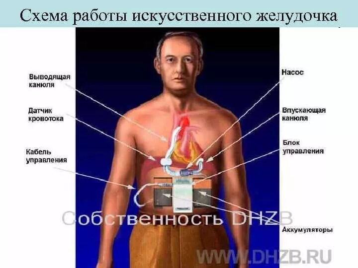 Искусственный желудочек сердца. Искусственный левый желудочек сердца. Искусственное сердце аппарат. Имплантация искусственного сердца.