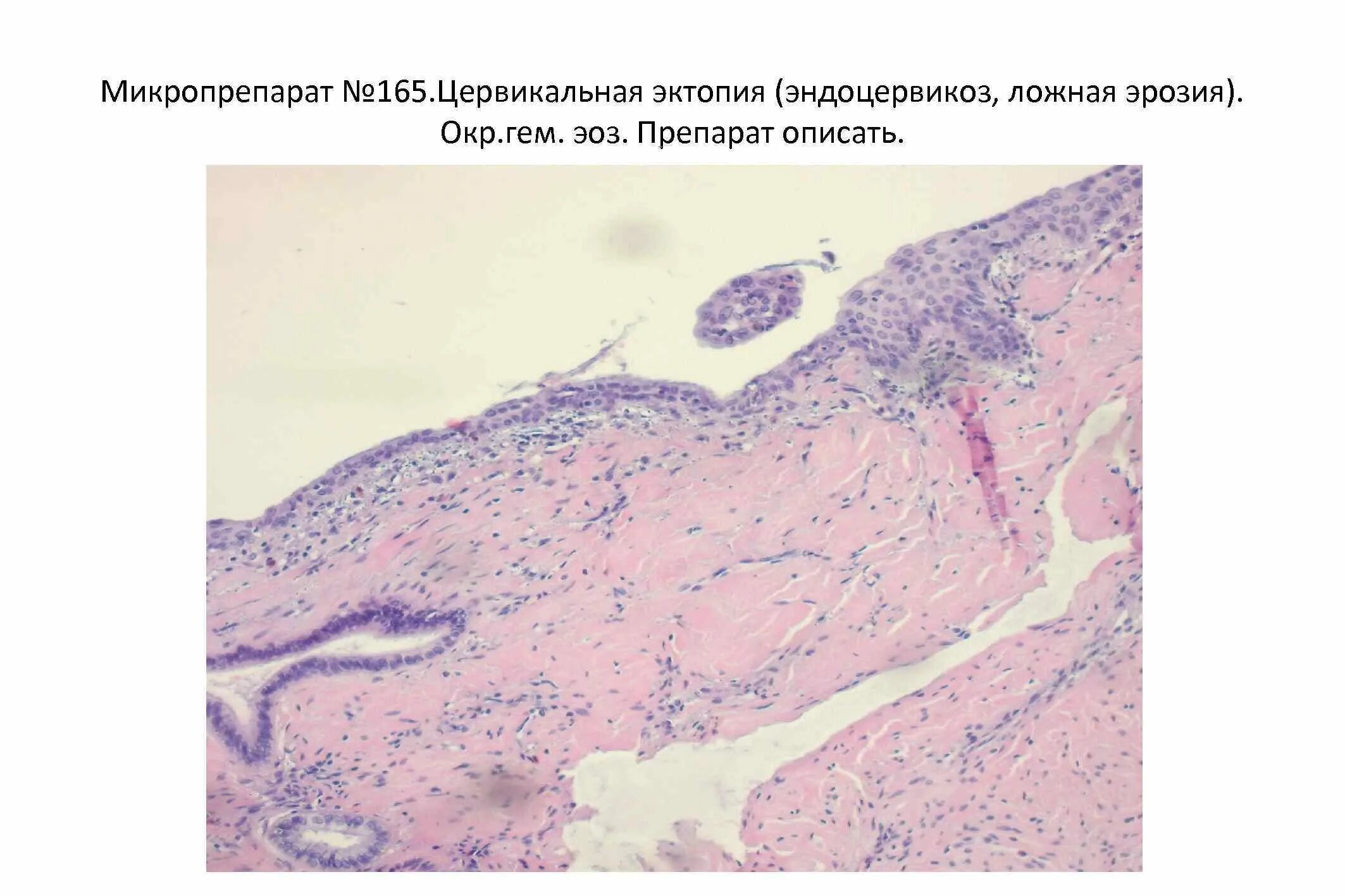 Nilm эндоцервикс. Nilm эндоцервикс