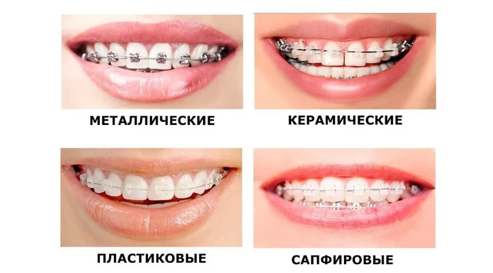 Примеры брекетов. Кривые зубы до и после брекетов. Самоподтягивающиеся брекеты. Брекеты h4 самолигирующие. Брекеты.
