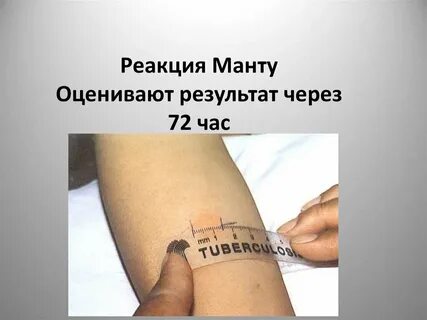 Фтизиатр проба манту