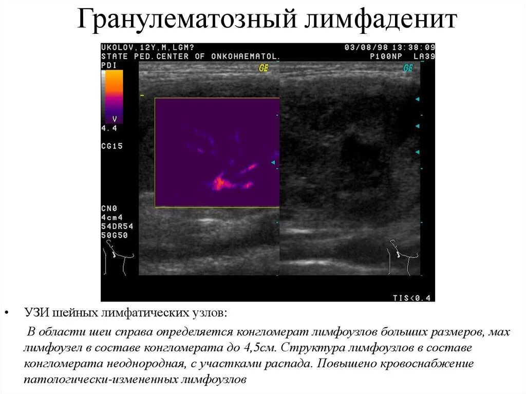 Конгломерат шейных лимфоузлов УЗИ. Структура лимфатического узла на УЗИ. Конгломерат лимфатических узлов на УЗИ. УЗИ анатомия лимфатических узлов. Неоднородные лимфоузлы