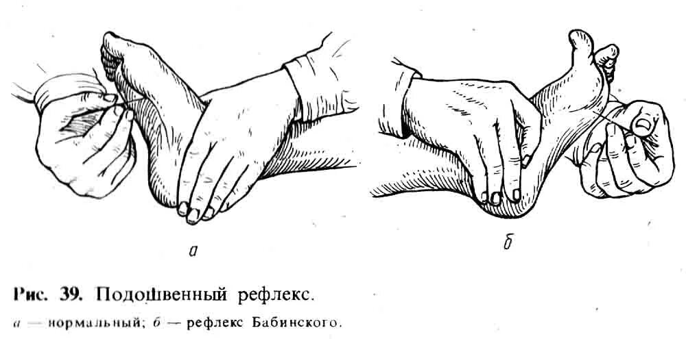 Подошвенный рефлекс Бабинского схема. Подошвенный рефлекс и рефлекс Бабинского. Патологические рефлексы симптом Бабинского. Рефлекс Бабинского при Центральном параличе.