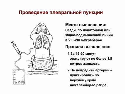Плевральная пункция