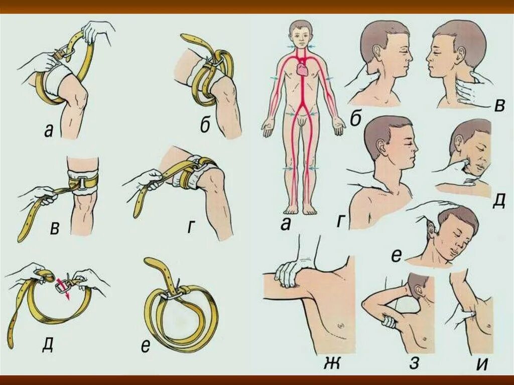 Жгут можно накладывать при кровотечении. Наложение жгута при кровотечениях. Наложение жгута при артериальном кровотечении. Артериальный жгут накладывают. Кровотечение наложение жгута.