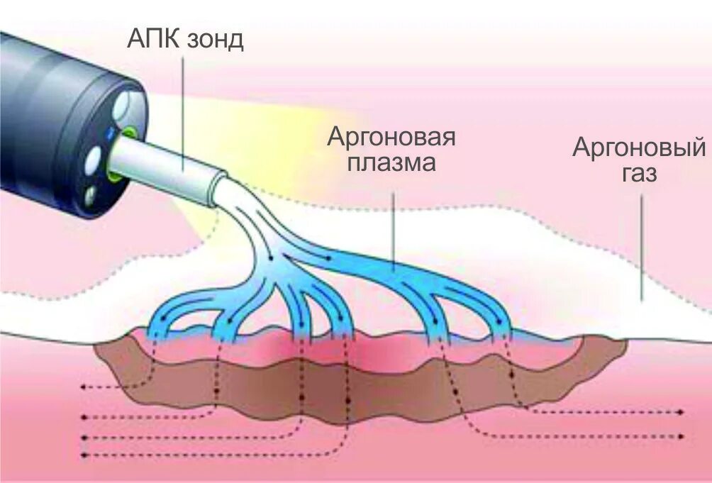 Аргон-плазменная коагуляция. Аргон-плазменная коагуляция пищевода. Аргоноплазменная коагуляция. Аргон плазменная коагуляция желудка. Абляция пищевода