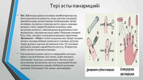 Антибиотик при панариции