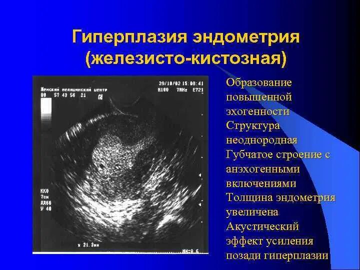 Атипическая гиперплазия эндометрия УЗИ. Гиперплазия эндометрия на УЗИ. Гиперплазия железисто кистозная эндометрит. Кистозная гиперплазия эндометрия на УЗИ.