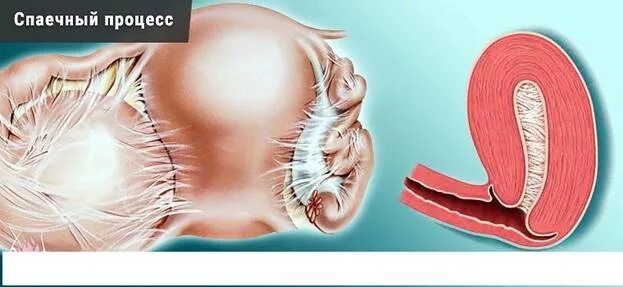 эксцизия маточной трубы. спайки органов малого таза на узи. можно ли забеременеть со спайками. спаечный процесс в маточных трубах. не проходимост моточни трубку.