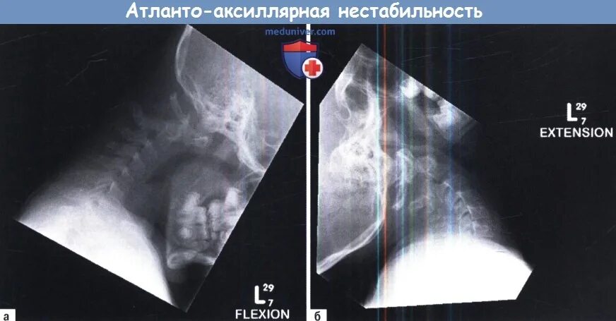 Аксиальная асимметрия. Артроз атланто-аксиального сочленения кт. Подвывих сустава крювелье. Асимметрия атланто-аксиального сочленения. Асимметрия атланто-аксиального сочленения.