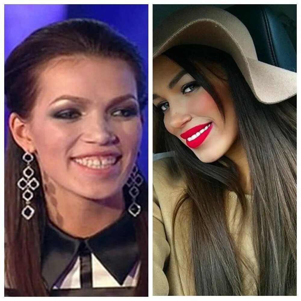 Дом 2 преображение. Ксения бородина пластика. Дом 2 преображение. Участницы дом 2 до и после пластики. Инесса шевчук виниры.