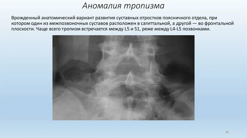 Аномалия 3 класса. Аномалия суставного тропизма. аномалия тропизма на рентгене. пороки развития позвоночника.