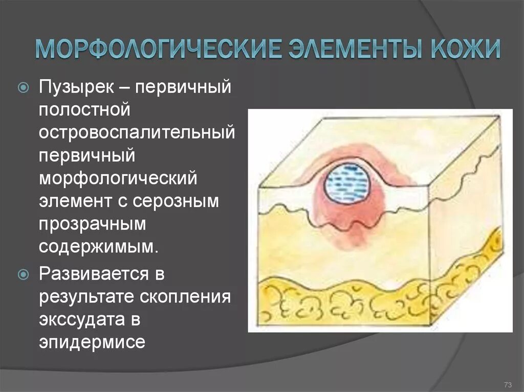 Вторичные элементы поражения. Первичные морфологические элементы кожи волдырь. Первичные бесполостные морфологические элементы кожи. Волдырь первичный морфологический элемент. Пузырек первичный морфологический элемент.