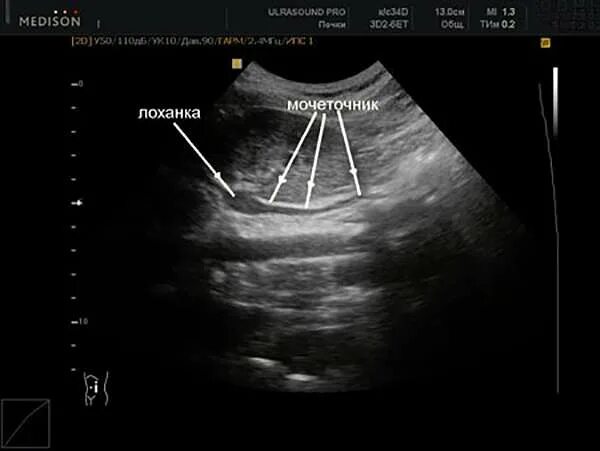 УЗИ почек, мочеточников и мочевого пузыря.. Расширение устья мочеточника на УЗИ. Камень верхней трети мочеточника УЗИ. УЗИ мочевого пузыря Устье мочеточника. Узи почка не видна