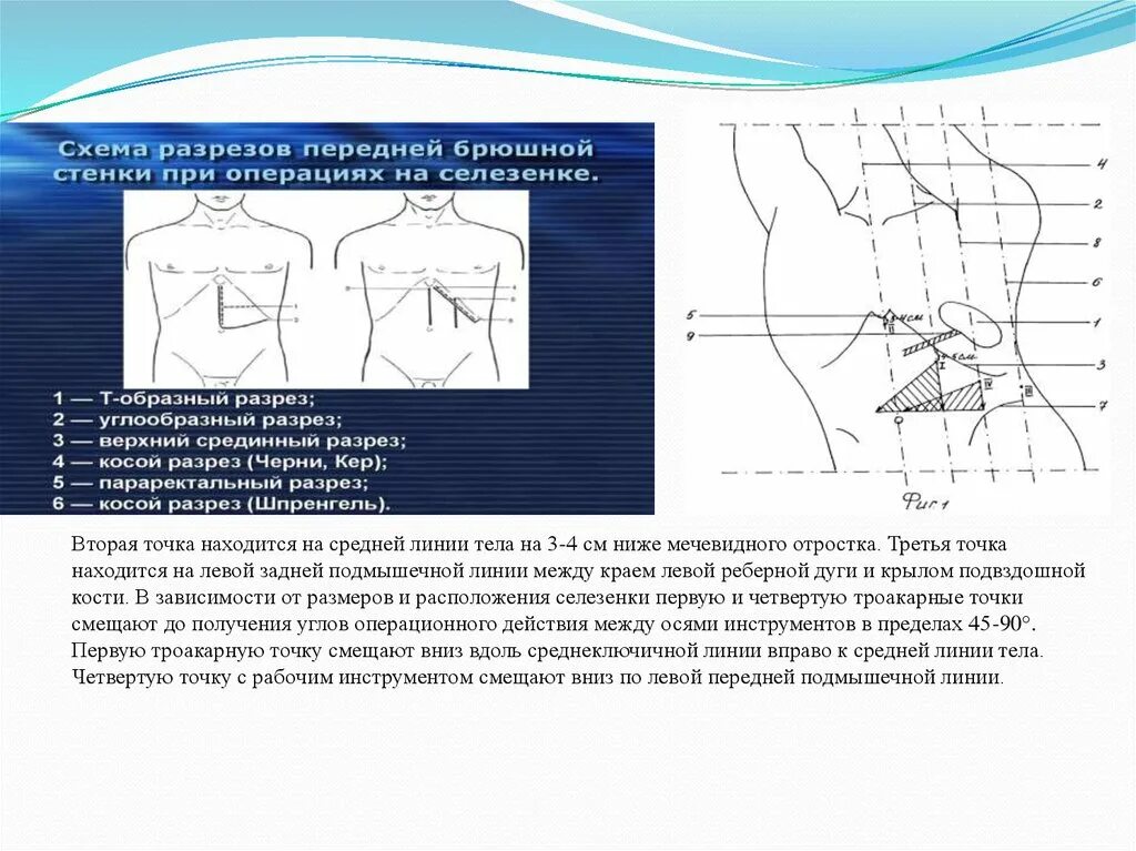 Схема разрезов при операциях на селезенке. Схема разрезов передней брюшной стенки при операциях на селезенке. Линии передней брюшной стенки. Схемы операций на передней брюшной стенке.