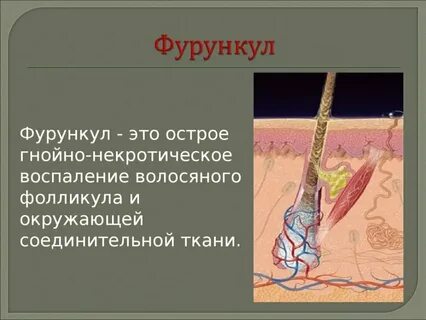 Гнойный сонник