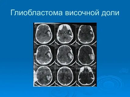 Опухоль височно
