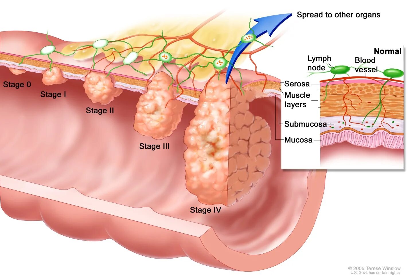 Распад кожи. Злокачественная опухоль толстой кишки. Полипы Толстого кишечника. Раковая опухоль толстой кишки.