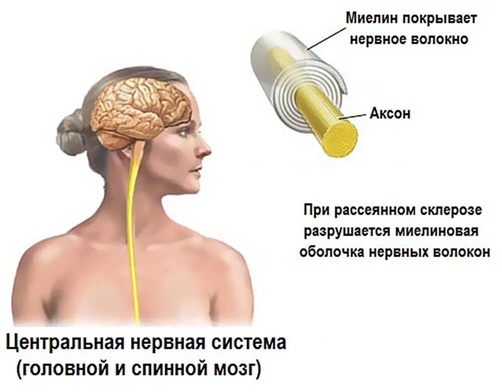 Склероз мозга. Рассеянный склероз. Склерозин. Головной мозг при рассеянном склерозе. Склероз картинки.