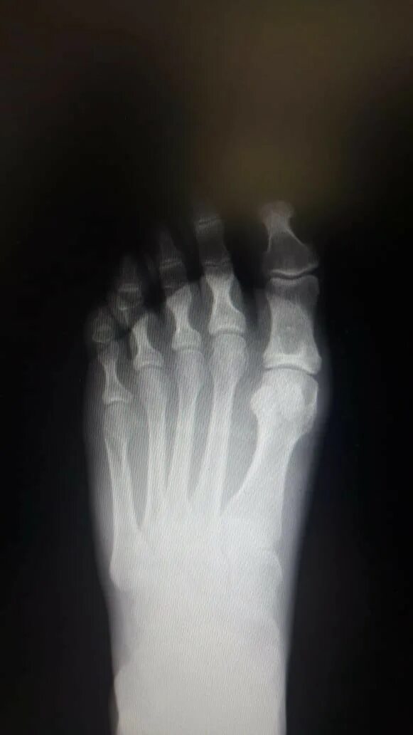 Снимок ноги рентген. Рентген стопы.