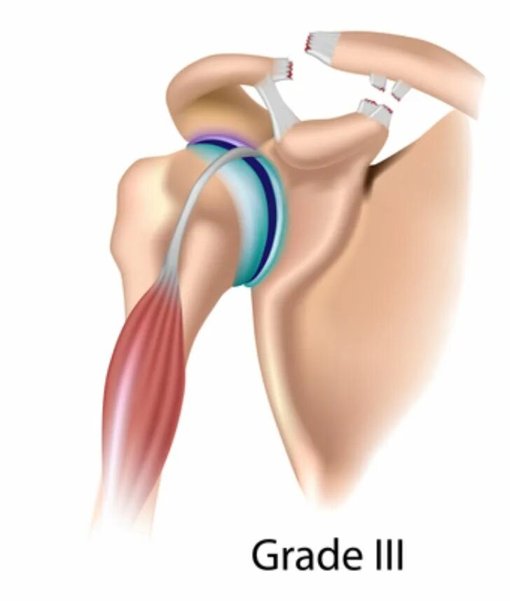 Разрыв надостной мышцы лечение. Импинджмент сухожилия надостной мышцы. Импиджмент плечевого сустава. Импиджмент синдром надостной мышцы. Разрыв клювовидно-плечевой связки.