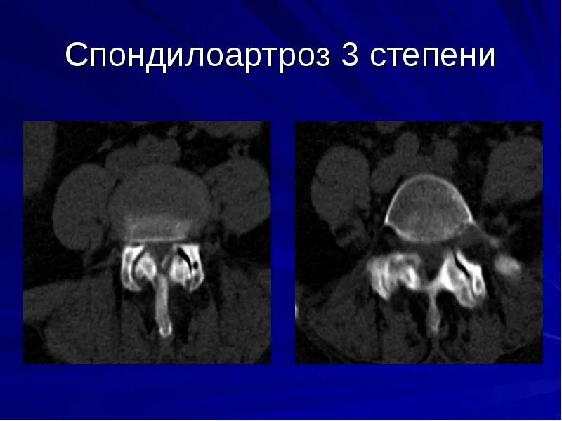 спондилоартроз 2 3 степени. спондилоартроз 1 степени поясничного отдела. спондилоартроз. спондилоартроз 3 степени кт. спондилоартроз поясничного отдела позвоночника что это такое.
