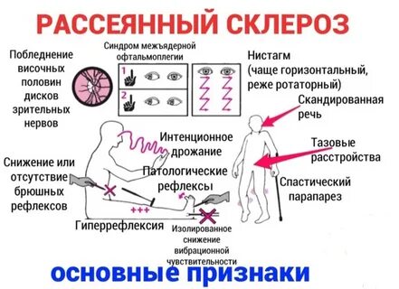 Склероз конечностей симптомы