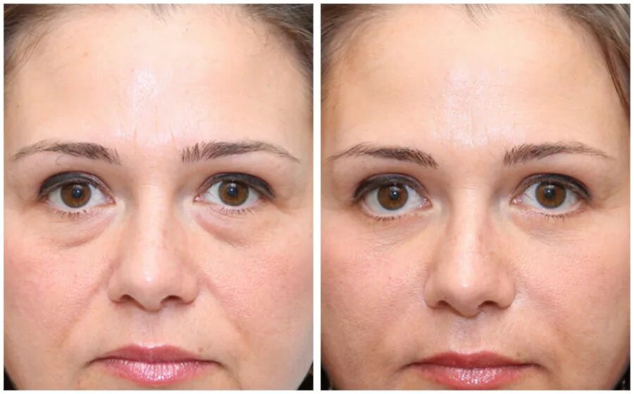 Биоревитализация под глазами. Радиесс носослезная борозда. Филлер в носогубные складки до и после. Ботокс в носогубную складку. Уколы гиалуроновой кислоты отеки.