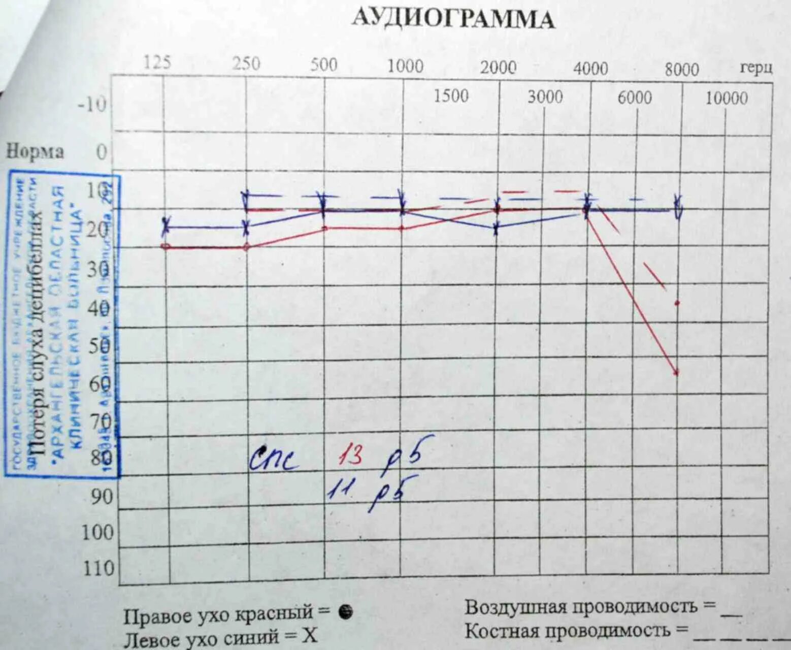 Аудиограмма при нормальном слухе. Расшифровка аудиометрии слуха норма. Аудиограмма слуха здорового человека. Аудиограмма слуха норма. Возрастное снижение слуха аудиограмма.