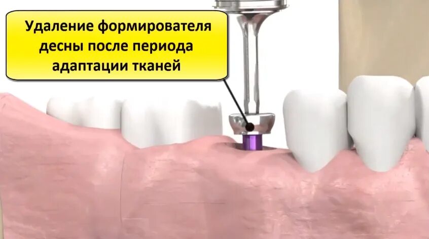 После установки формирователей