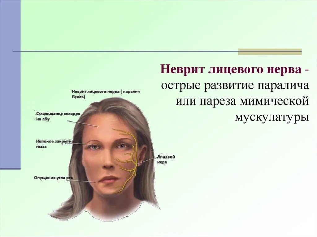 Лицевой нерв после операции. Неврит лицевого нерва. Острый неврит лицевого нерва. Неврит лицевого лицевого нерва.