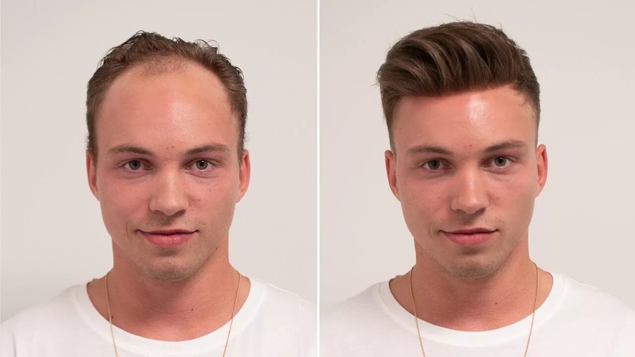 Волосы форум мужчины. Система замещения волос для мужчин. Протез волос для мужчин. Интеграция волос для мужчин. Мужские стрижки до и после.