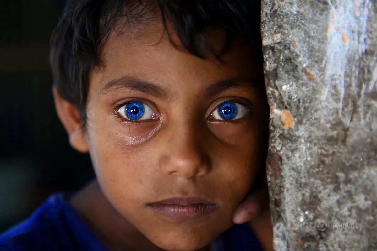 ваарденбурга синдром ваарденбурга. самый необычный цвет глаз. необычные глаза у людей. какой самый редкий человек в мире. редкий цвет глаз.