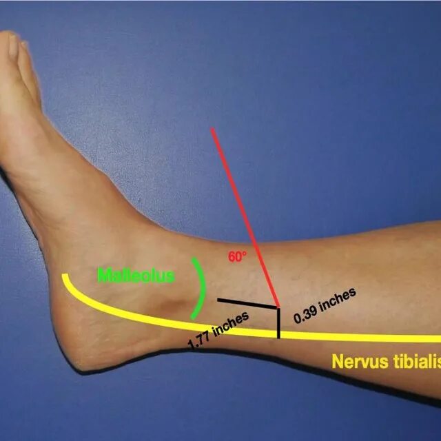 N suralis. Нервус тибиалис. Suralis нерв. Paralysis of nervus Tibialis. Nervus Tibialis проходит в.