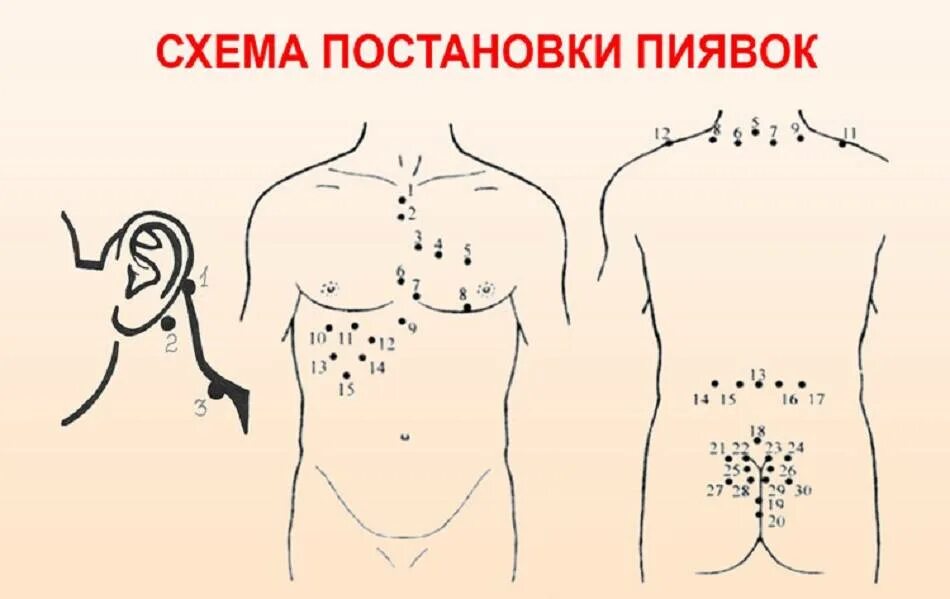 Схема постановки пиявок при различных. Схема лечения пиявками при заболевании печени. Гирудотерапия места постановки пиявок. Гирудотерапия схема постановки пиявок при заболеваниях. Постановка пиявок на печень.