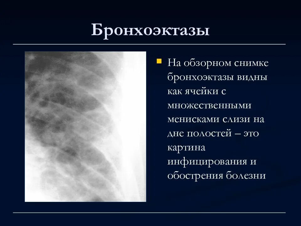 Бронхоэктатическая болезнь диагноз. Бронхоэктатическая болезнь рентген. Бронхоэктатическая болезнь рентген описание. Мешотчатые бронхоэктазы на кт. Бронхоэктатическая болезнь легкого рентген.