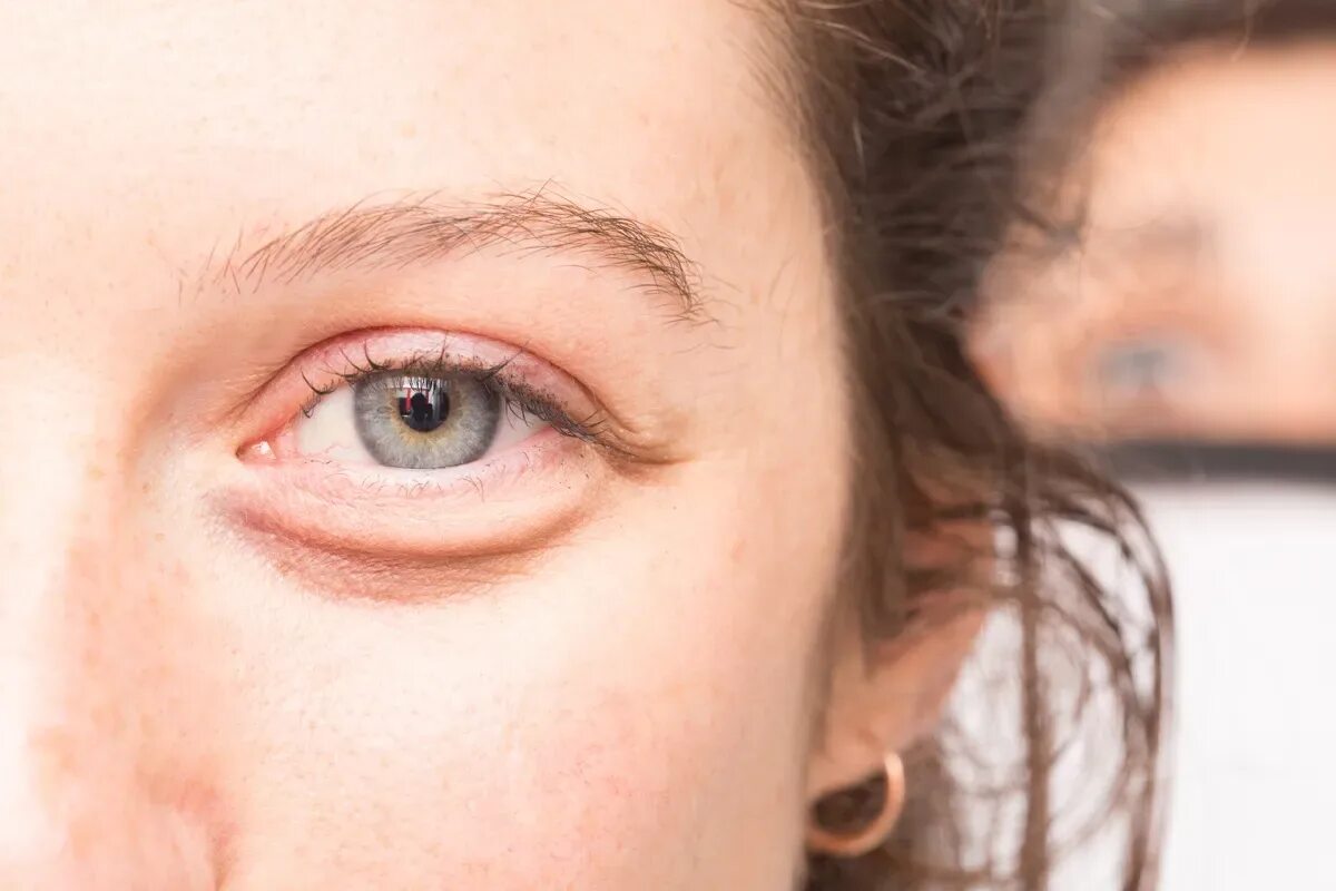 Черные круги под глазами причины заболевания. Припухлости вокруг глаз. Мешки вокруг глаз.