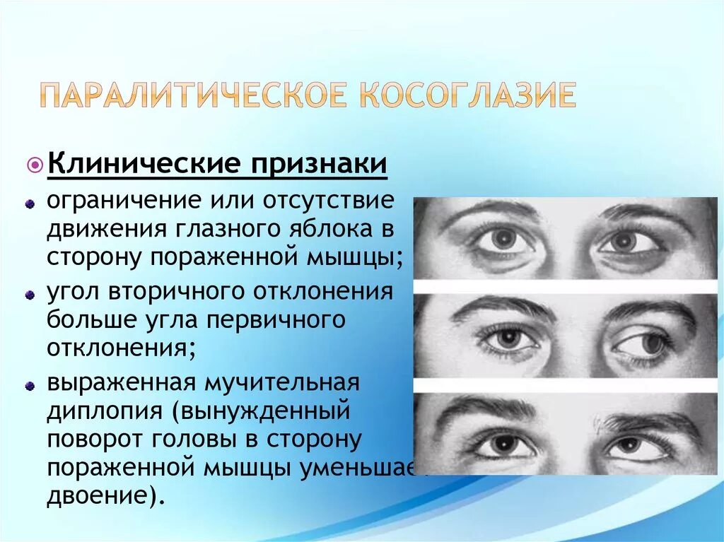 Нарушение движения глаз. Содружественное и паралитическое косоглазие. Паралитическое расходящееся косоглазие. Паралитисеское комогоазие. Крсоглазие назалетичечкое.