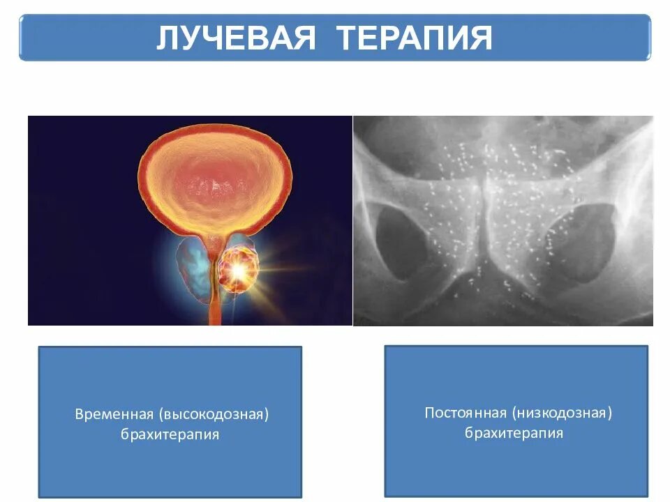 Простата после облучения. Брахитерапия предстательной железы. Лучевая терапия предстательной железы. Дучевая тераптяпредстательной железы.