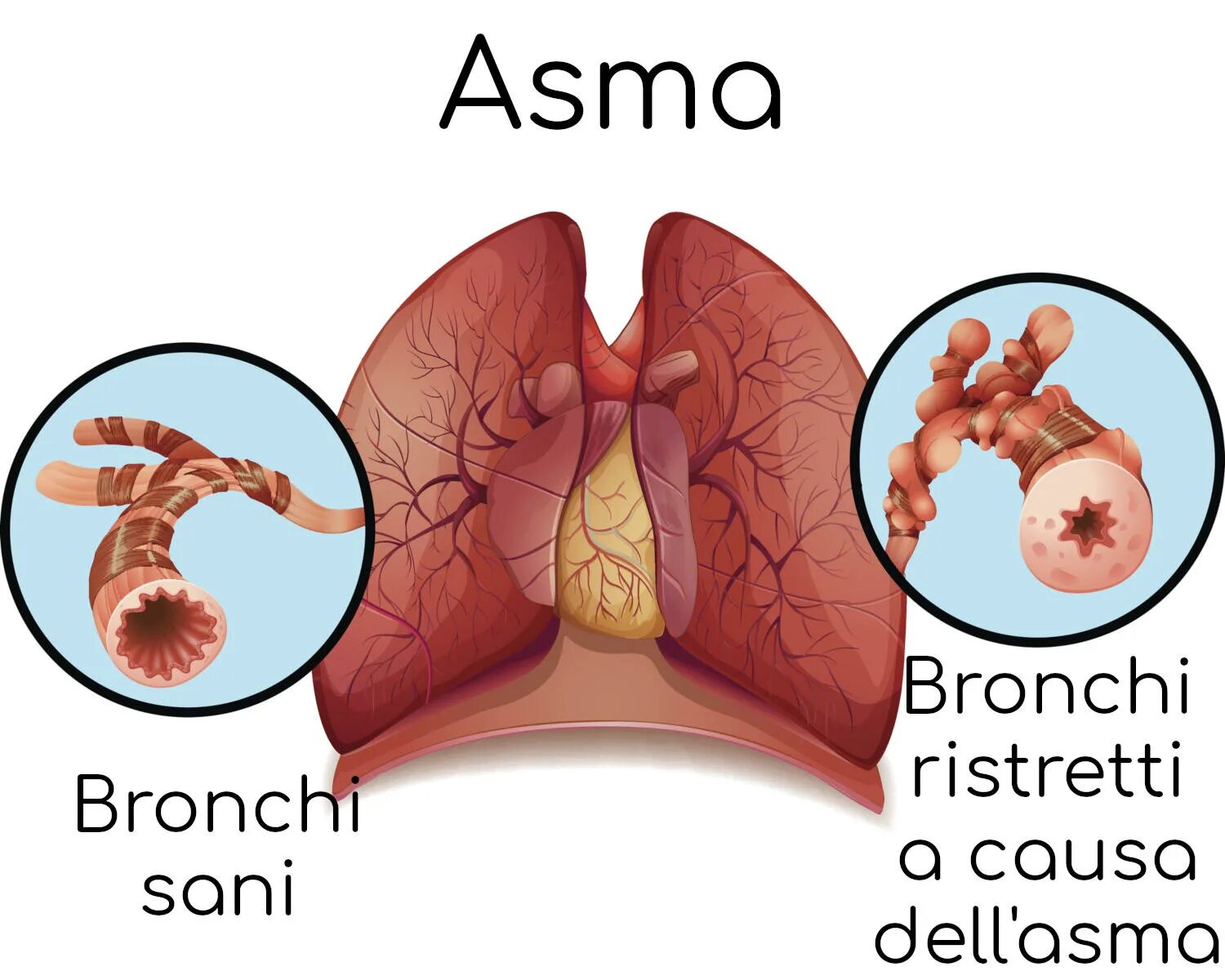 Bronchial asthma