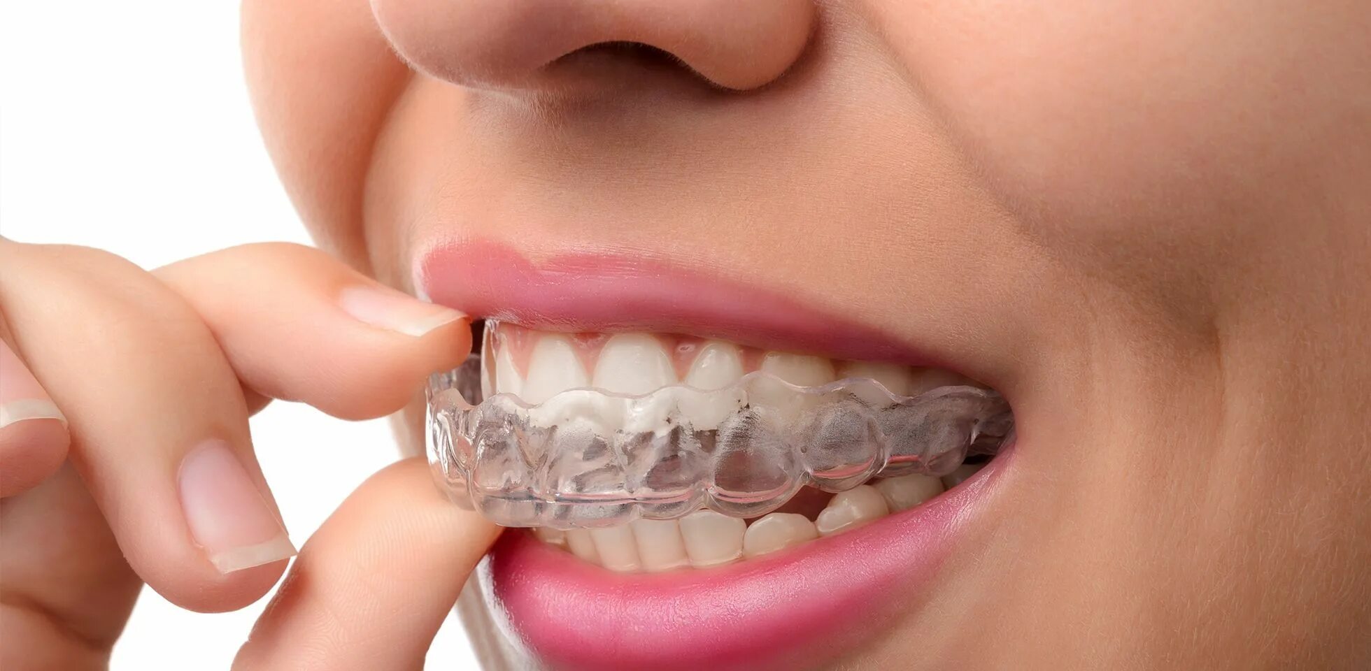 Ортодонтия что это. Элайнеры Star smile. Элайнеры Invisalign. Ортодонтическая Капа элайнеры. Элайнеры Инвизилайн.