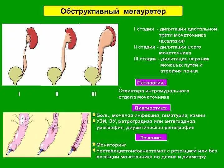 Мочеточник дистальный. Мегауретер степени классификация. Стадии нейромышечной дисплазии мочеточника. Обструктивный мегауретер. Мегауретер у детей классификация.