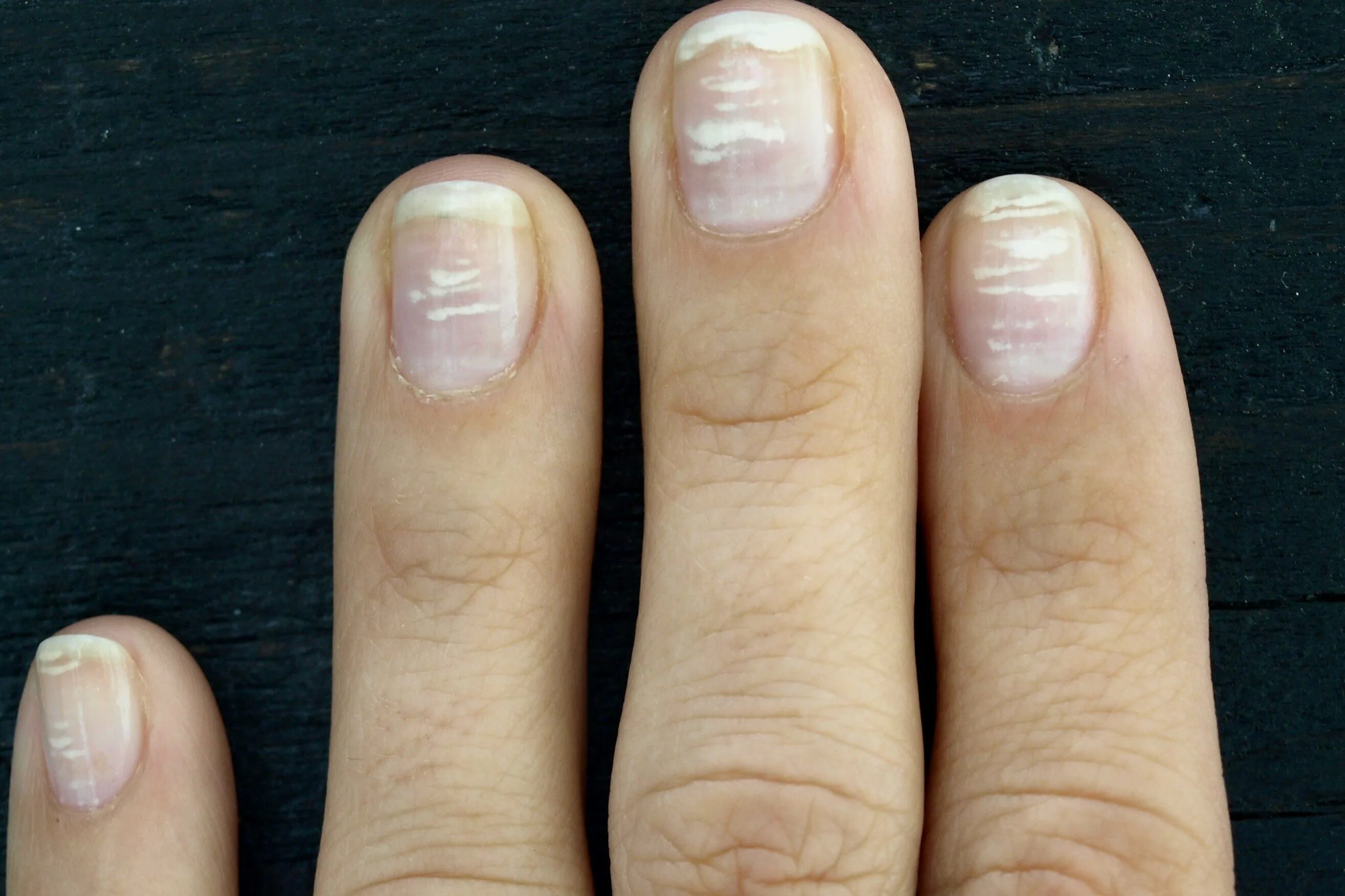 Лечение продольных полос на ногтях. Лейконихия белые пятна на ногтях. Лейконихия (белые пятнышки).
