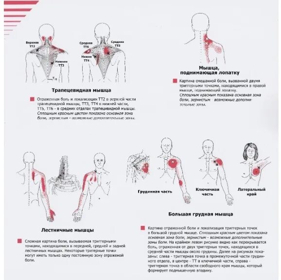 Тт1 триггерная точка. Триггерные точки схема атлас. Триггерные точки и отраженная боль карта. Триггерные точки на спине грудной отдел. Триггерные точки это простыми словами
