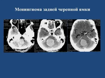 Содержимое средней черепной ямки