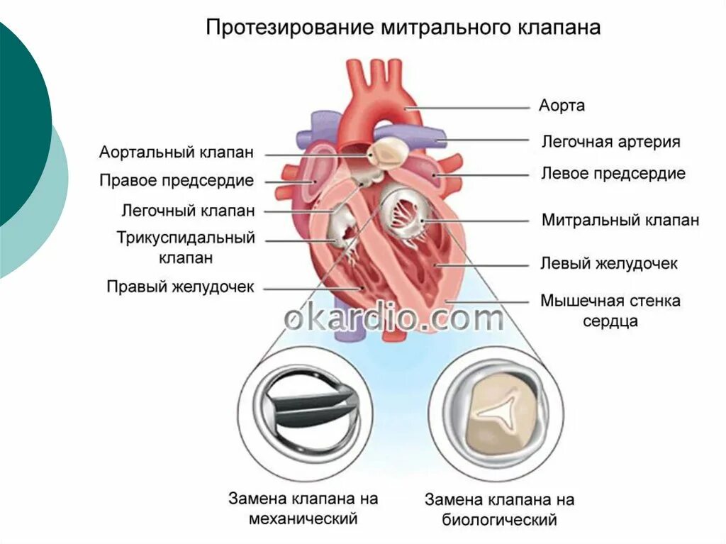 Клапаны сердца аортальный клапан. Митральный клапан и аортальный клапан. Протезирование митрального клапана. Сердце операция митральный клапан. Как клапан делает операция