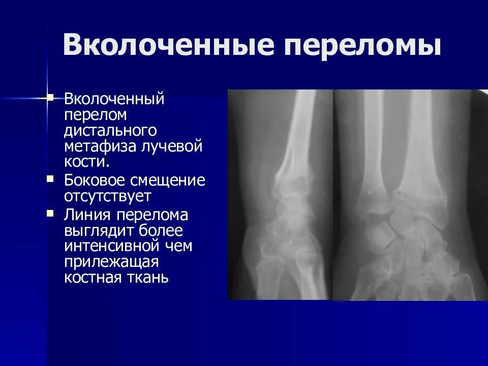 Перелом дистального метафиза лучевой. Вколоченный перелом метаэпифиза лучевой кости. Перелом лучевой кости со смещением рентген. Вколоченный перелом рентген.